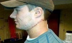 Will Weber, con cien puntos de sutura en la barbilla. | Foto: Twitter
